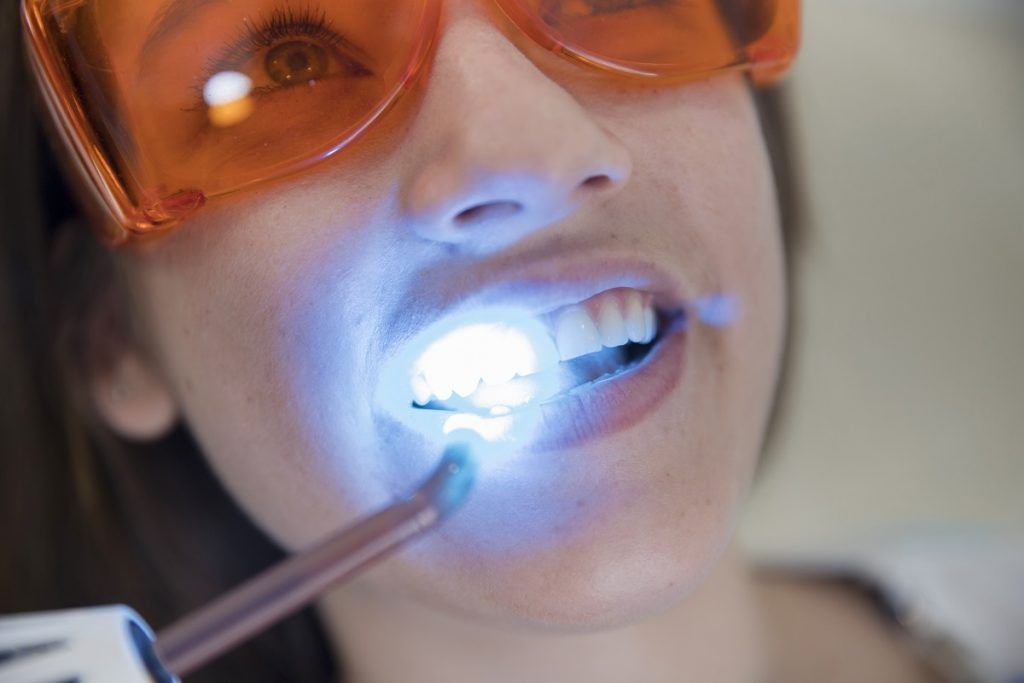 blanqueamiento-dental-para-una-sonrisa-blanca-y-brillante-clinica-dental-granvia-alicante
