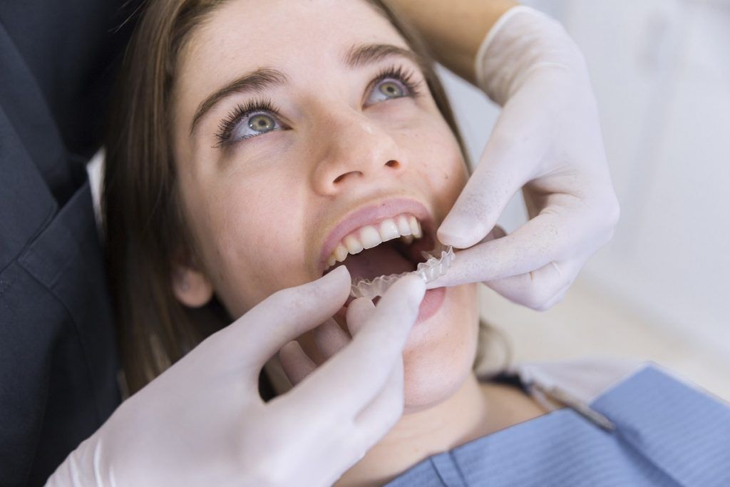 blanqueamiento-dental-para-una-sonrisa-blanca-y-brillante-clinica-dental-granvia-alicante